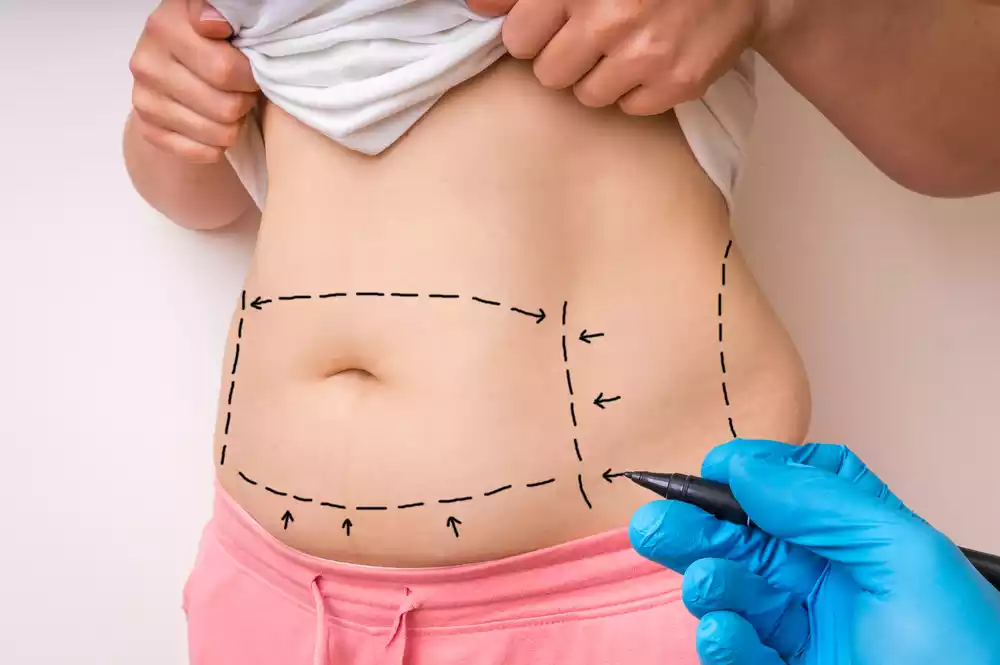 tummy tuck recovery