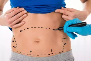 how to know if you need a tummy tuck