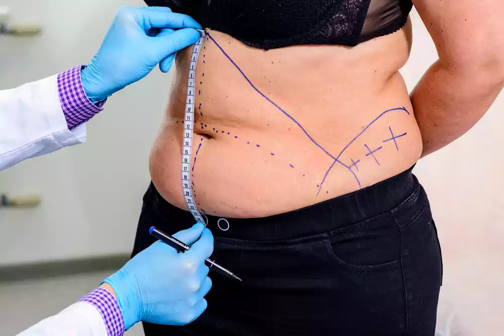 what tummy tuck does